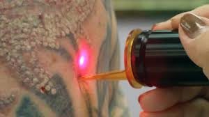 Best skin numbing for laser procedures